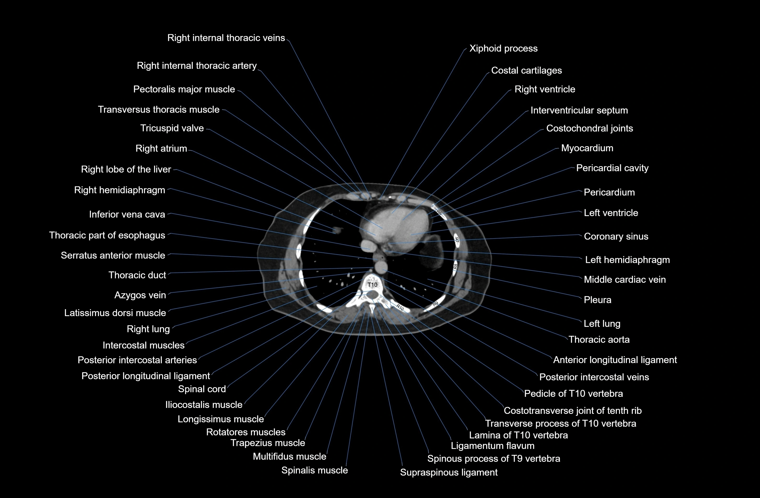 CT Abdomen axial cross sectional anatomy labelled radiology image-00005.webp